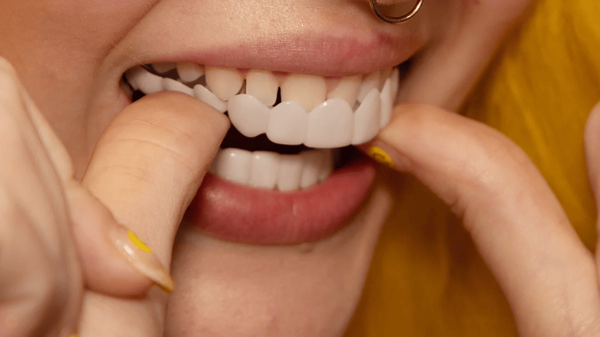 Easy Smile Makeover with Clip On Teeth Veneers