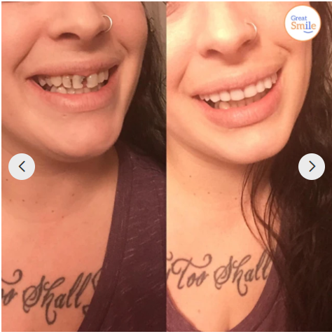 Easy Fit Dental Implant Kit | Buy 1 Get 1 Free