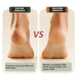 Easy Foot Callus Remover