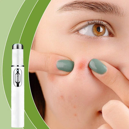 Easy Acne Remover for Clear Skin