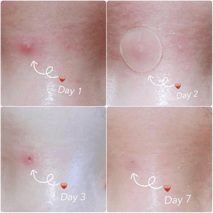 Fast Healing Pimple and Spot Patch