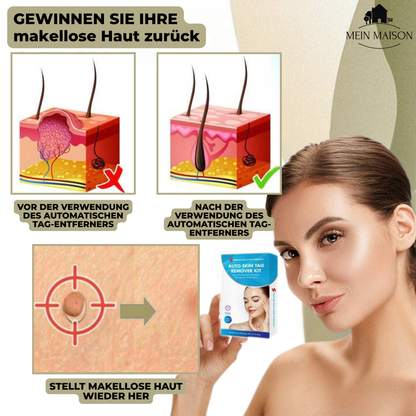 Easy Wart and Mole Remover for Home Use