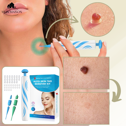 Easy Wart and Mole Remover for Home Use