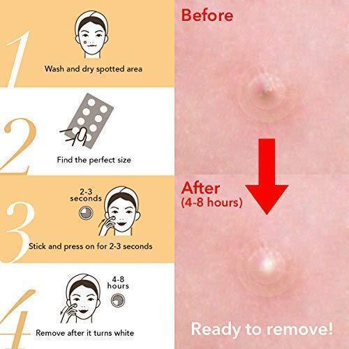 Fast Healing Pimple and Spot Patch