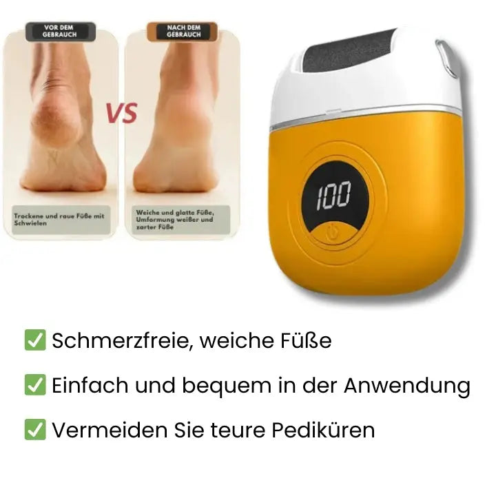 Easy Foot Callus Remover - Fesara