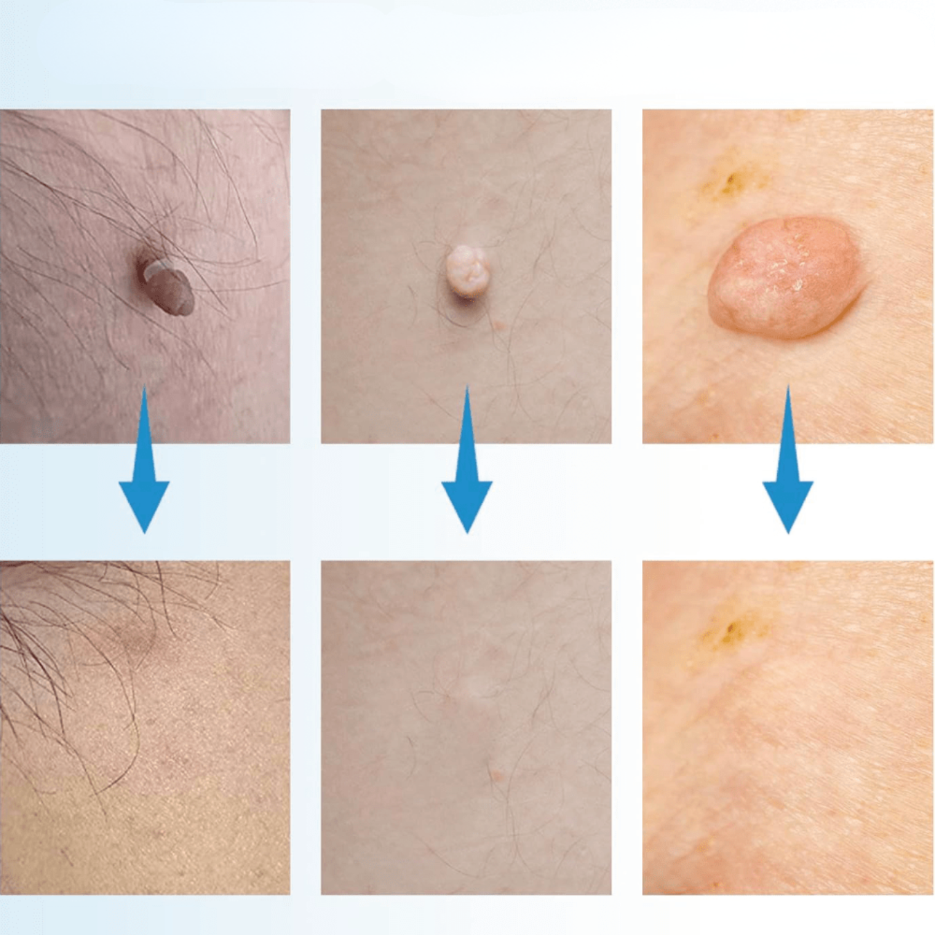 Fast Acting Wart Removal Cream