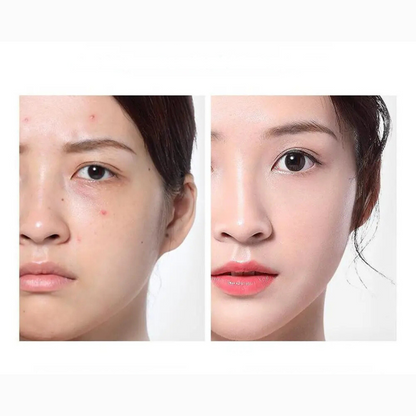 Glowing Skin Face Toner - Pimple Control & Hydrating Serum