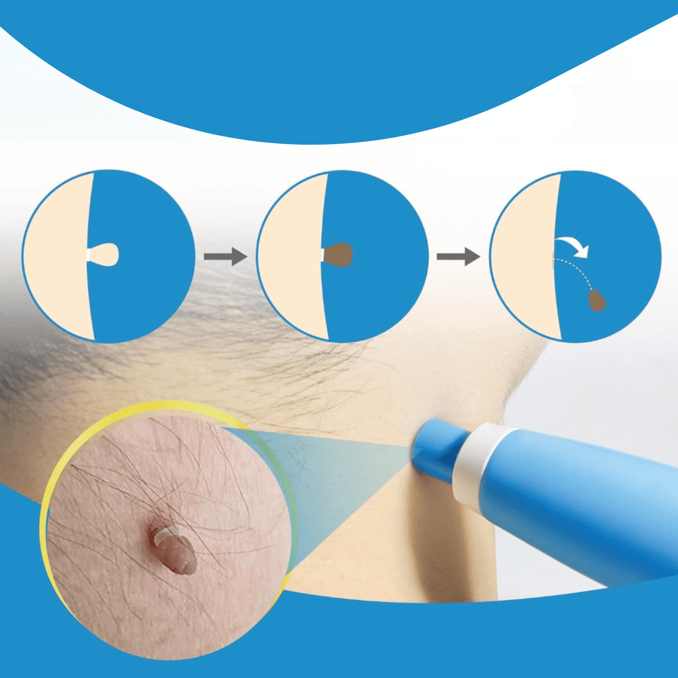 Fast Acting Wart Removal Cream
