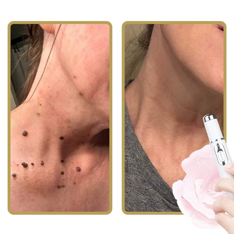 Easy Acne Remover for Clear Skin