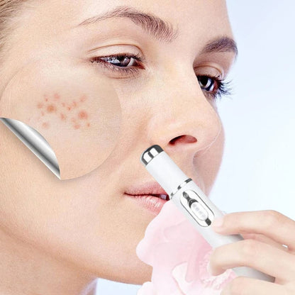 Easy Acne Remover for Clear Skin