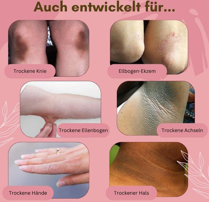 Fast Relief Foot Cream for Dry Itchy Feet