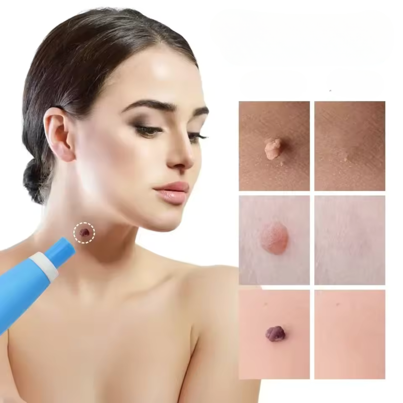 Fast Acting Wart Removal Cream - Fesara