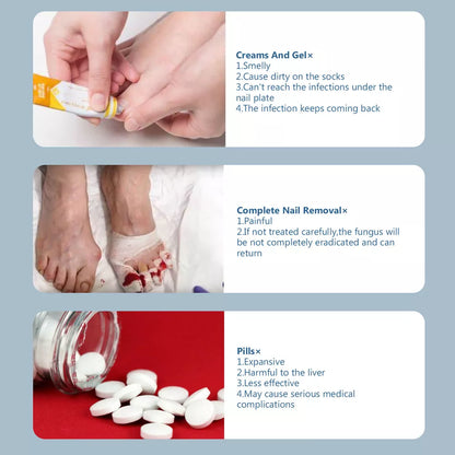 Advanced Fungal Nail Laser Treatment Device