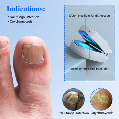 Advanced Fungal Nail Laser Treatment Device