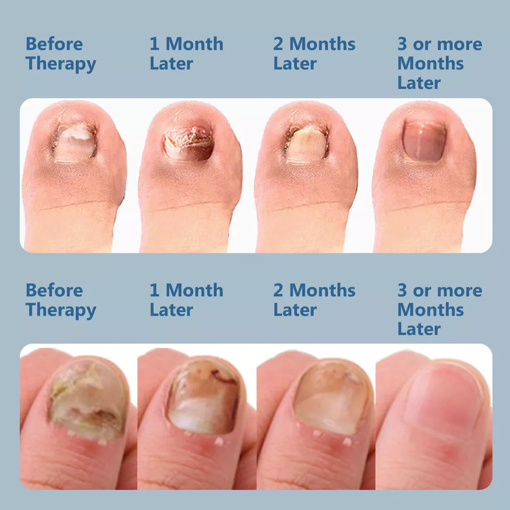 Advanced Fungal Nail Laser Treatment Device