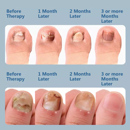 Advanced Fungal Nail Laser Treatment Device