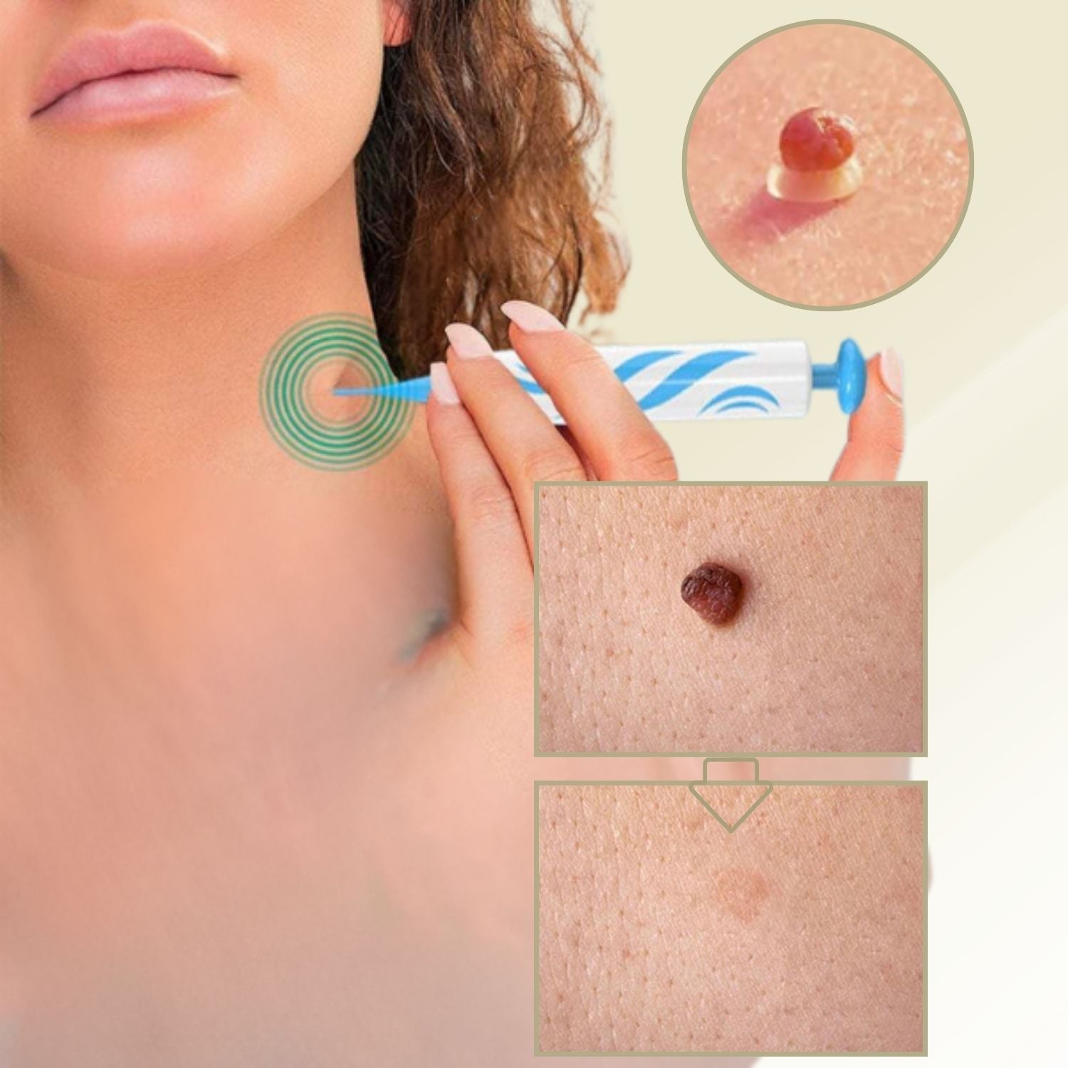 Easy Wart and Mole Remover for Home Use - Fesara