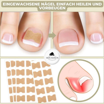 FixaNail – Gentle nail correction against ingrown nails and pain 1