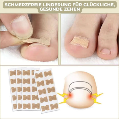 FixaNail – Gentle nail correction against ingrown nails and pain 2