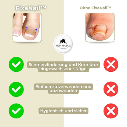 FixaNail – Gentle nail correction against ingrown nails and pain 5