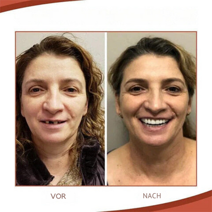 Comfortable Silicone Dental Prosthesis Set for Natural Smile - Fesara