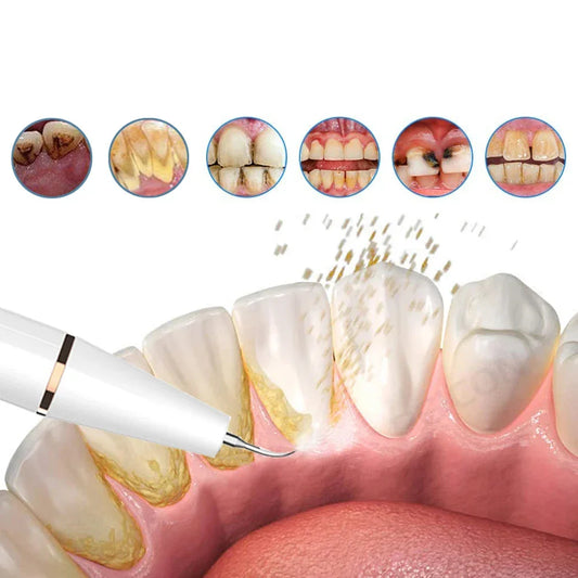 Professional Dental Plaque & Tartar Remover - Fesara
