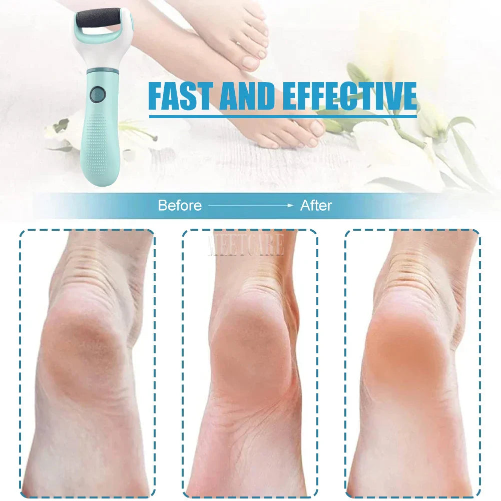 Rechargeable Foot Callus Remover for Dry Skin