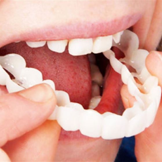Vivolux | SmileSnap - Always the perfect smile with these veneers 1