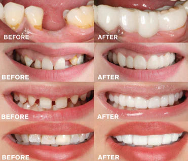 Easy Fit Dental Implant Kit | Buy 1 Get 1 Free