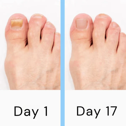Fesara | Advanced Nail Fungus Remover Device