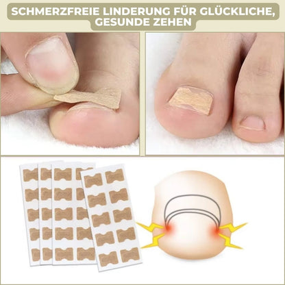 Easy To Use Nail Correction Strips for Ingrown Nails