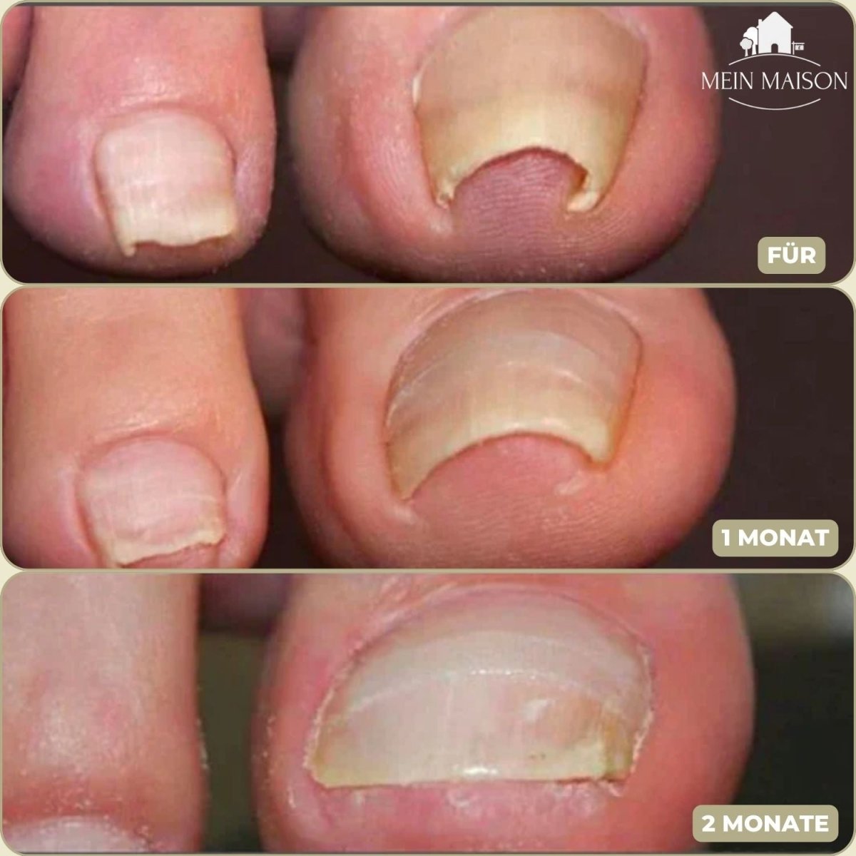 Easy To Use Nail Correction Strips for Ingrown Nails