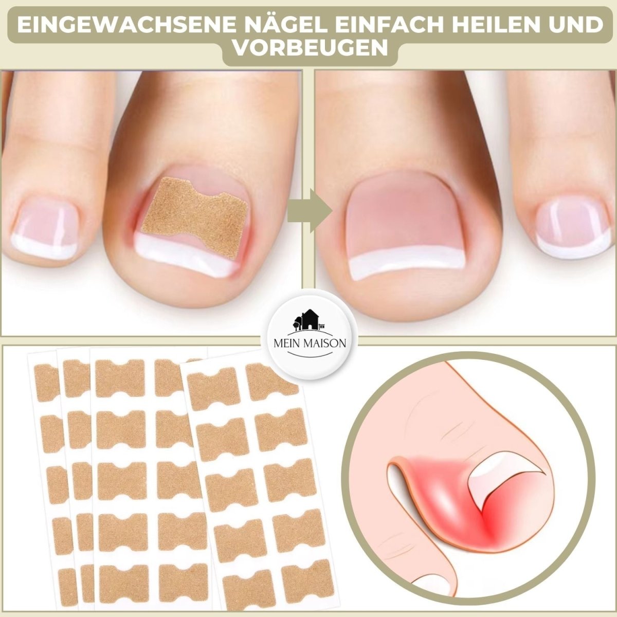 Easy To Use Nail Correction Strips for Ingrown Nails