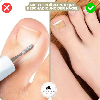 Easy To Use Nail Correction Strips for Ingrown Nails
