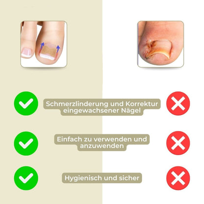 Easy To Use Nail Correction Strips for Ingrown Nails