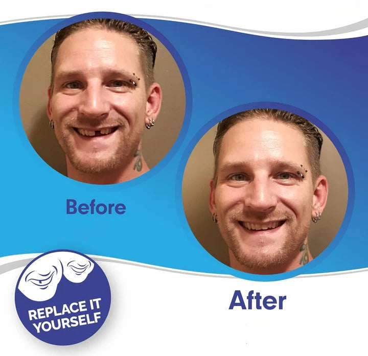 Reusable Snap On Smile Veneers for Top and Bottom Teeth