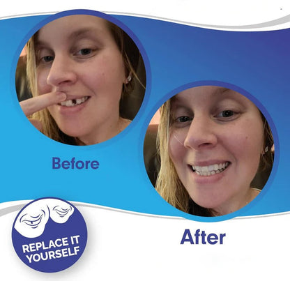 Reusable Snap On Smile Veneers for Top and Bottom Teeth